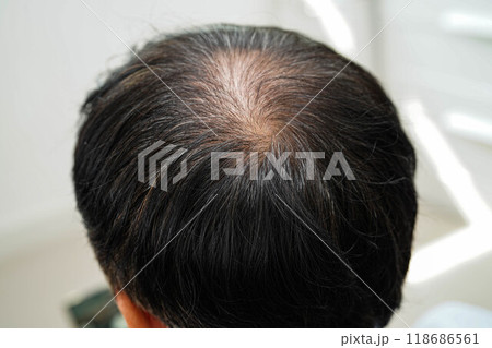 Bald head in man, hair loss treatment health problem. 118686561