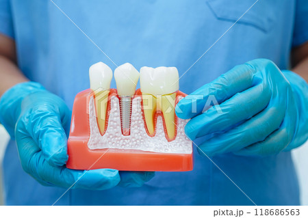 Dentist holding dental implant, artificial tooth roots into jaw, root canal of dental treatment, gum disease, teeth model for dentist. Dentist holding dental implant, artificial tooth roots into jaw, root canal of dental treatment, gum disease, teeth model for dentist. 118686563