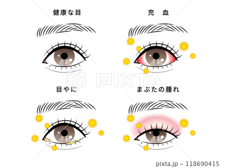 目のトラブルセット(花粉) 目のトラブルセット(花粉) 118690415