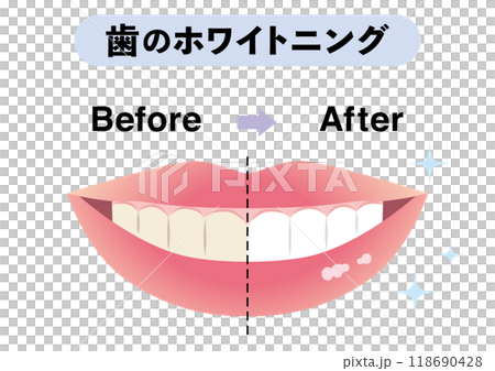 Before and after teeth whitening 118690428