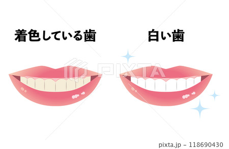 着色している歯と白い歯 118690430