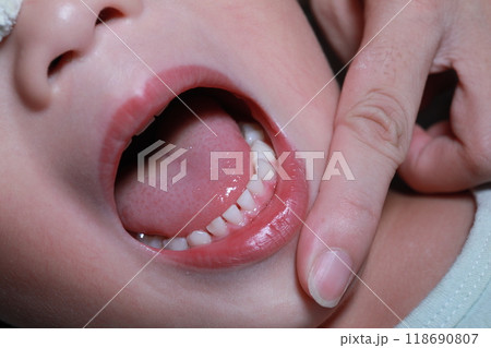 乳歯 キッズ 子供 118690807