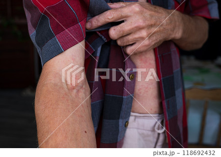 Hives (urticaria) on the inner elbow of a man. Hives (urticaria) on the inner elbow of a man. 118692432