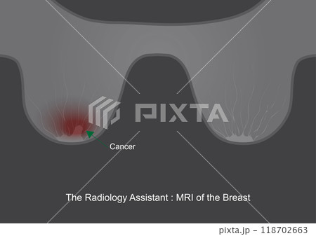 The Radiology Assistant MRI of the Breast. The Radiology Assistant MRI of the Breast. 118702663