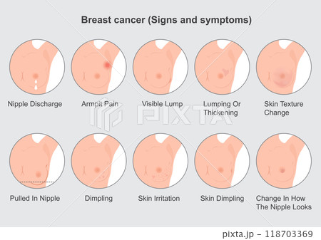Breast cancer caught early is the most treatable kind of breast cancer. 118703369