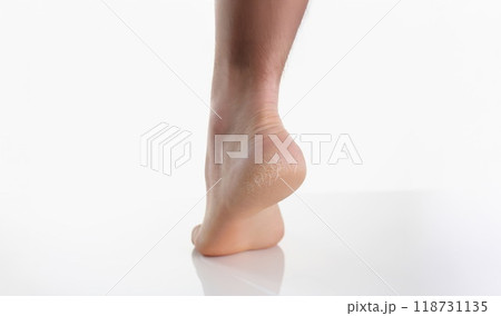Single female leg or heel showing dried cracked heel with dried skin Single female leg or heel showing dried cracked heel with dried skin 118731135