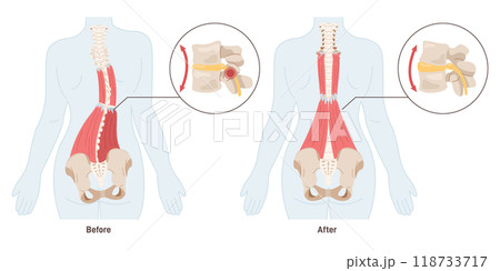 Massage effect. Back pain treatment and muscles relaxation. Spasmed muscle of a vertebral column and pinching nerve physical rehabilitation. Flat vector illustration Massage effect. Back pain treatment and muscles relaxation. Spasmed muscle of a vertebral column and pinching nerve physical rehabilitation. Flat vector illustration 118733717