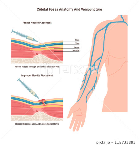Blood test techique. Phlebotomy, venipuncture and collection of blood from the vein technique. Proper syringe placement. Arm vein placement. Flat vector illustration 118733893