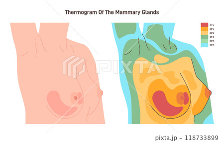 Thermography of female chest. Thermographic image of breast, showing different temperatures spectrum. Breast cancer screening. Flat vector illustration Thermography of female chest. Thermographic image of breast, showing different temperatures spectrum. Breast cancer screening. Flat vector illustration 118733899
