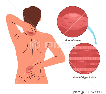Back pain. Character having neck and shoulder muscle spasm. Trigger point in muscle tissue. Myositis, strained muscle inflamation. Flat vector illustration. Back pain. Character having neck and shoulder muscle spasm. Trigger point in muscle tissue. Myositis, strained muscle inflamation. Flat vector illustration. 118733906