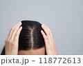 A woman has a problem with hair loss. 118772613