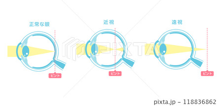 正常な眼と近視・遠視のピント位置 ベクターイラスト 正常な眼と近視・遠視のピント位置 ベクターイラスト 118836862