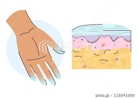 Second frostbite stage infographic vector isolated Second frostbite stage infographic vector isolated 118841000