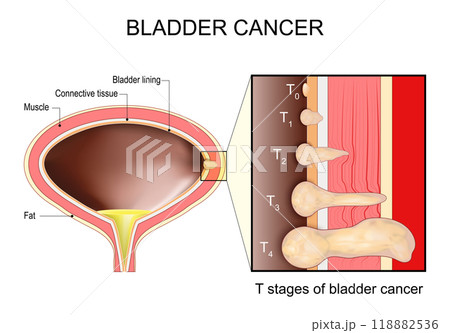 Bladder cancer Stages 118882536