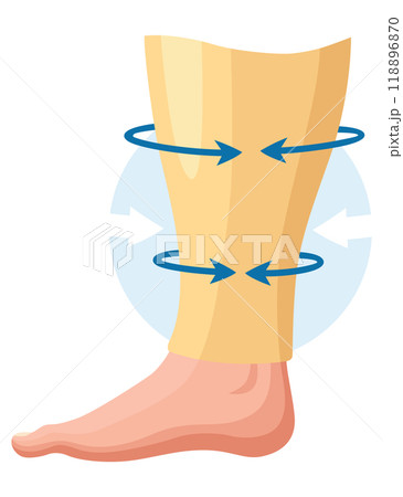 Stages or types of varicose veins development. Medical poster or disease infographic. Image of diseased legs. Vector illustration in flat style Stages or types of varicose veins development. Medical poster or disease infographic. Image of diseased legs. Vector illustration in flat style 118896870