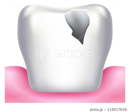 Broken tooth with hole in enamel. Dental treatment illustration 118917659