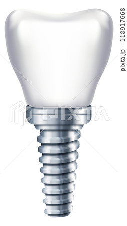 Tooth implant. Dental prosthesis. Stomatology medical illustration 118917668