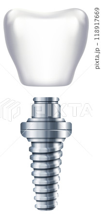 Dental implant scheme. Tooth replacement. Orthodontic illustration 118917669