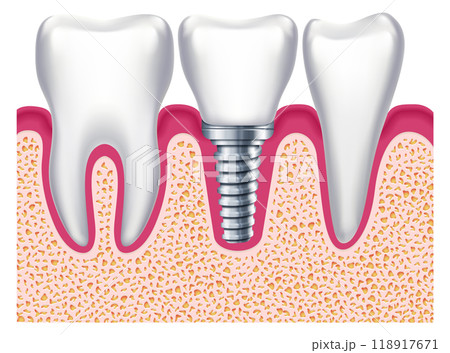 Implant among healthy teeth. Dental treatment. Stomatology prosthesis Implant among healthy teeth. Dental treatment. Stomatology prosthesis 118917671