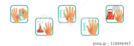 Hand Burn Degree and First Aid Procedure Vector Set Hand Burn Degree and First Aid Procedure Vector Set 118946467