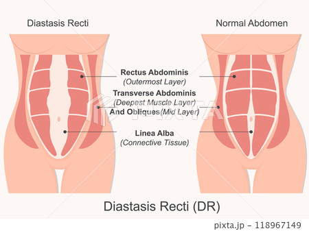 Diastasis Recti (DR) is condition in pregnant and postpartum people. 118967149