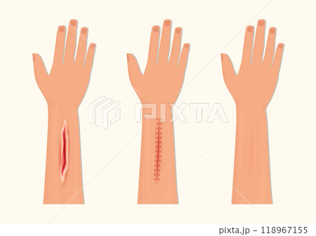 Wound Suturing and Suture Care. 118967155