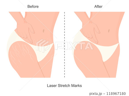 Before and after laser stretch marks removal. Before and after laser stretch marks removal. 118967180