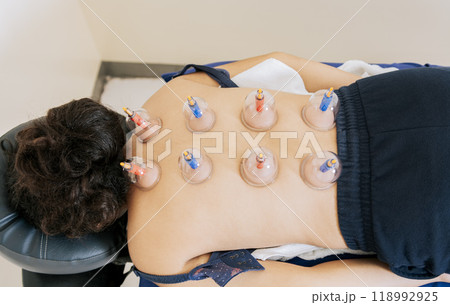 Patient lying down with suction cups on her back. Physiotherapy cupping on a lying patient. Close-up of suction cups on the patient back, Acupuncture cupping on the back of a person lying down Patient lying down with suction cups on her back. Physiotherapy cupping on a lying patient. Close-up of suction cups on the patient back, Acupuncture cupping on the back of a person lying down 118992925