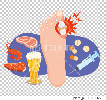 痛風發作的影像說明 痛風發作的影像說明 119024220