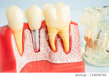Dental implant, artificial tooth roots into jaw, root canal of dental treatment, gum disease, teeth model for dentist studying about dentistry. 119048788