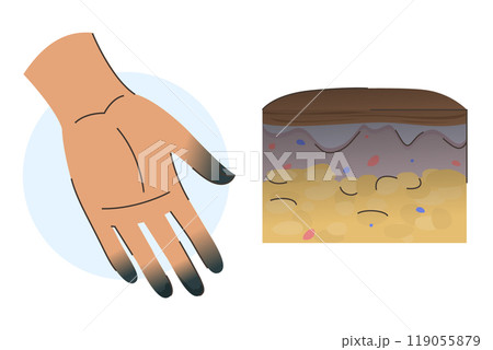 Third frostbite stage infographic vector isolated 119055879