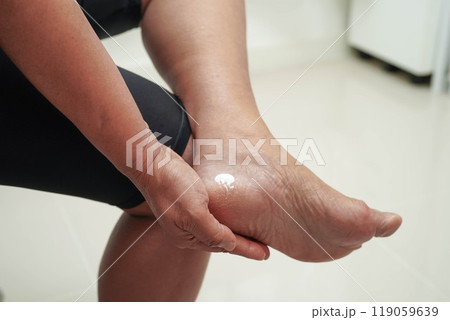 Asian woman applying moisturizing cream skincare treatment to solve and repair feet with crack and dry heel skin. 119059639