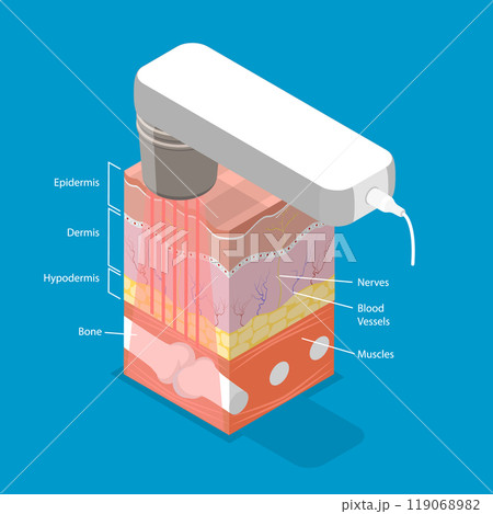 3D Isometric Flat Vector Illustration of Laser Therapy, Alleviating Patient Pain And Stimulate Healing 3D Isometric Flat Vector Illustration of Laser Therapy, Alleviating Patient Pain And Stimulate Healing 119068982