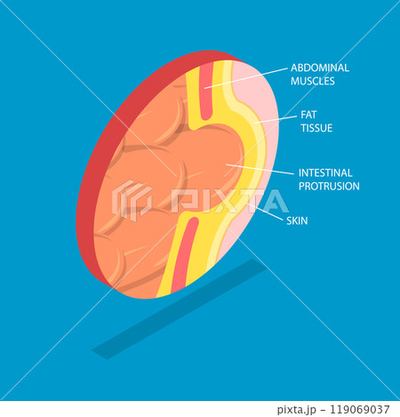 3D Isometric Flat Vector Illustration of Hernia, Health Issues Related To The Abdomen And Intestines 119069037