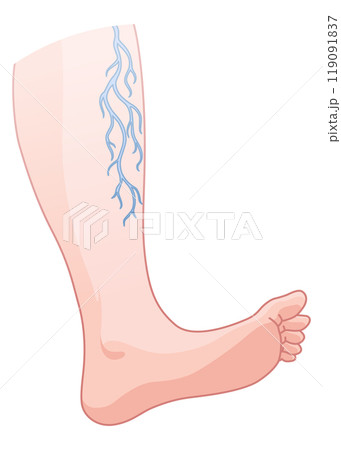 Varicose veins. Blue blood vessel visible through the skin, abnormally swollen leg. Vascular disease diagnostic and treatment. Venous insufficiency medical disease 119091837