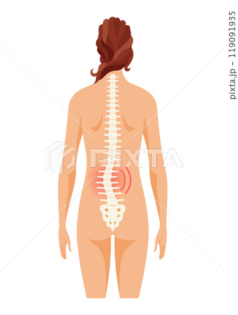 Scoliosis affecting individuals of all ages. Schematic poster of a woman with scoliosis 119091935