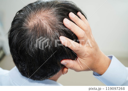 Bald head in man, hair loss treatment health problem. Bald head in man, hair loss treatment health problem. 119097268