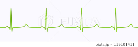 ECG of type 3 long QT syndrome, 3D illustration ECG of type 3 long QT syndrome, 3D illustration 119101411