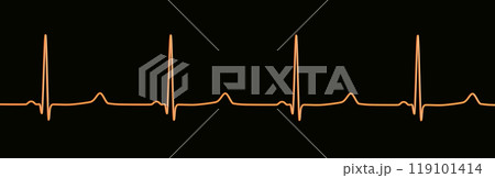 ECG of type 3 long QT syndrome, 3D illustration ECG of type 3 long QT syndrome, 3D illustration 119101414