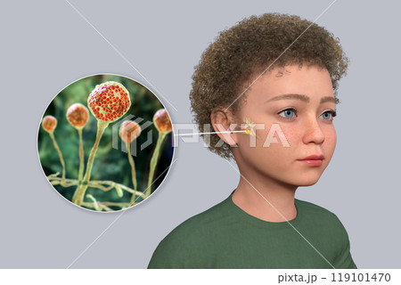 Otitis media in a child, 3D illustration Otitis media in a child, 3D illustration 119101470