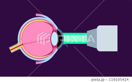 Lasik eye surgery Lasik eye surgery 119105424