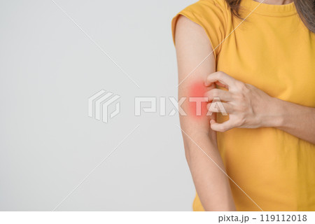 woman itching and scratching itchy arm. Sensitive Skin Allergic reaction to insect bite, food, drug dermatitis. Dermatology, Leprosy day, Systemic lupus erythematosus, Allergy symptoms and rash Eczema woman itching and scratching itchy arm. Sensitive Skin Allergic reaction to insect bite, food, drug dermatitis. Dermatology, Leprosy day, Systemic lupus erythematosus, Allergy symptoms and rash Eczema 119112018