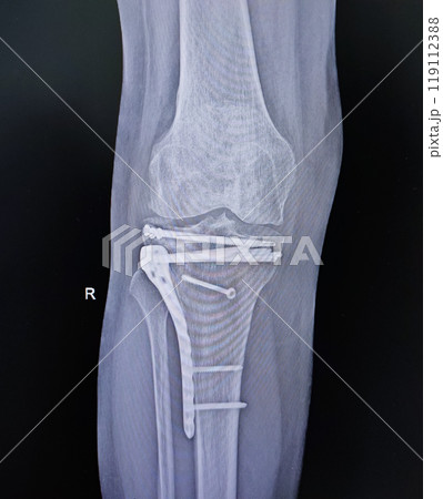 Structure of knee and rx-ray image of knee, tibia fracture with post operation internal fixation. Structure of knee and rx-ray image of knee, tibia fracture with post operation internal fixation. 119112388