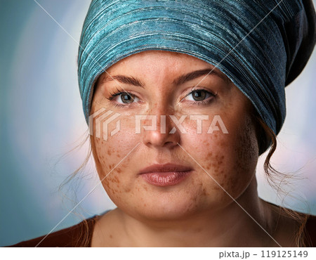 Woman Suffering From Sun Damage Actinic Keratosis 119125149