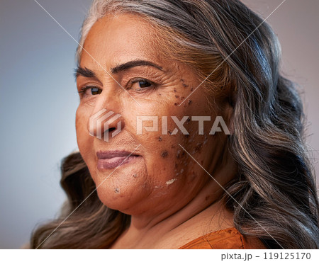 Woman Suffering From Sun Damage Actinic Keratosis 119125170