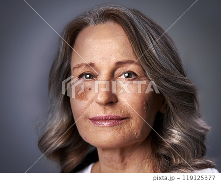 Woman Suffering From Sun Damage Actinic Keratosis 119125377