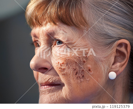 Woman Suffering From Sun Damage Actinic Keratosis 119125379