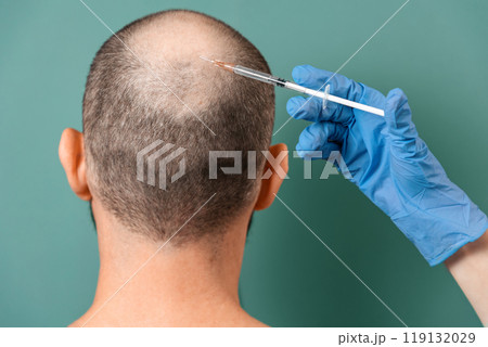A man with alopecia on his head during a mesotherapy procedure with a trichologist. Back view. Turquoise background. The concept of baldness and professional treatment 119132029