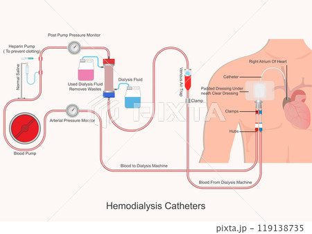 Hemodialysis catheters are an essential part of kidney. Hemodialysis catheters are an essential part of kidney. 119138735