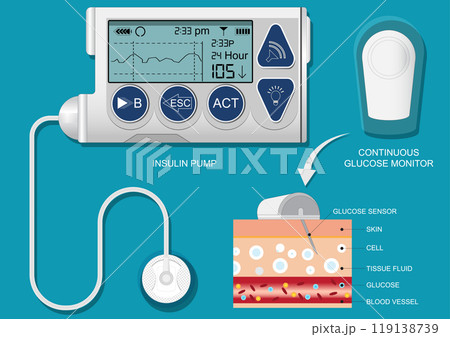 Insulin pump is an electronic device. 119138739